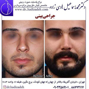 جراحی بینی