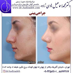 جراحی بینی