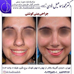 جراحی بینی گوشتی