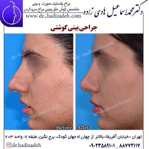 جراحی بینی گوشتی