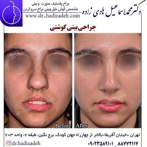 جراحی بینی گوشتی