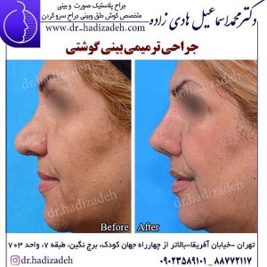 جراحی ترمیمی بینی