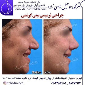 جراحی ترمیمی بینی