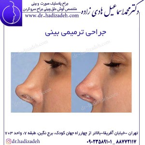جراحی ترمیمی بینی