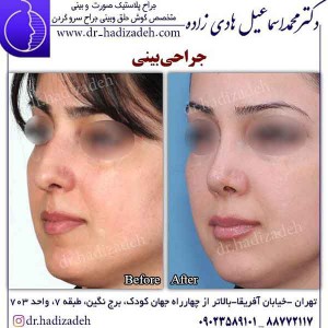 جراحی بینی طبیعی