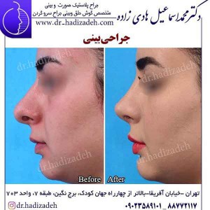 جراحی بینی طبیعی