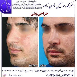 جراحی بینی طبیعی