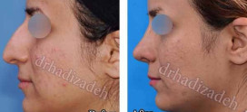 جراحی زیبایی بینی