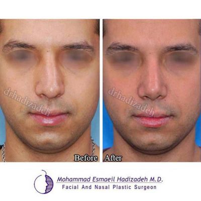 جراحی بینی آقایان 3