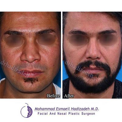 جراحی بینی آقایان 6