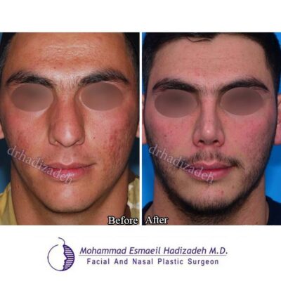 تصاویر جراحی بینی گوشتی 7-1
