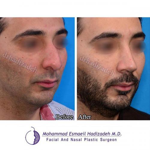 تصاویر جراحی بینی آقایان 17-8