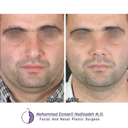 1-7 تصاویر جراحی بینی آقایان