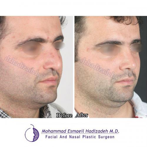 7-7 تصاویر جراحی بینی آقایان